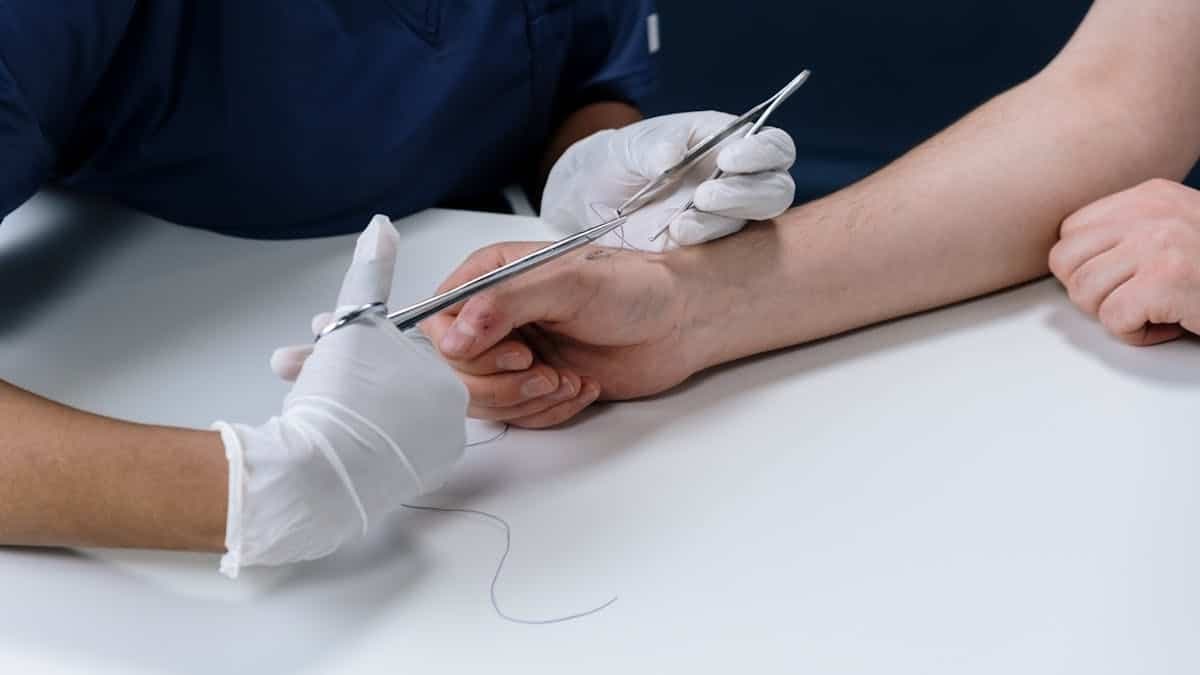 Quanto tempo leva a cirurgia do túnel do carpo?