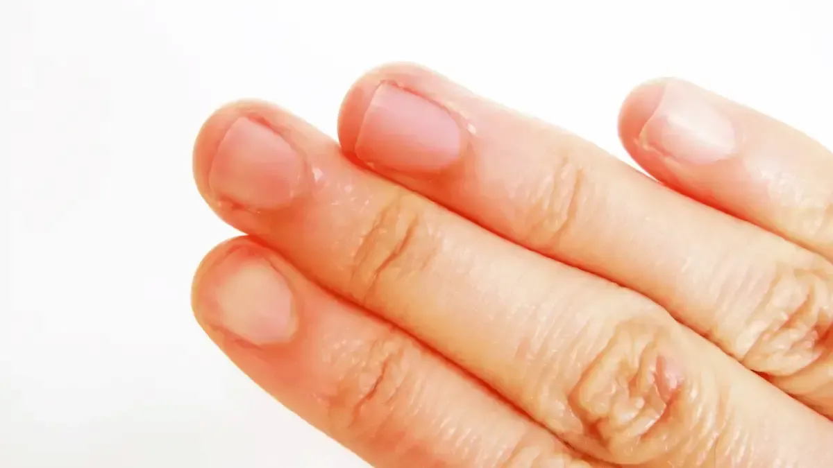 Sensação de queimação na ponta dos dedos das mãos: o que é